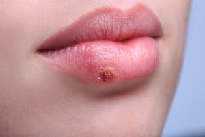 was hilft gegen Herpes - Lippenherpes