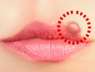 Was hilft gegen Lippenherpes