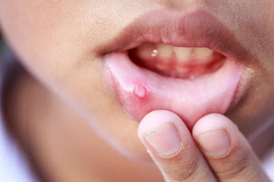 Hausmittel Gegen Herpes Im Mund Diese Helfen Wirklich