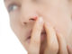 Nasenherpes - Herpes in der Nase