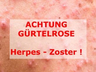 Herpes-Zoster Gürtelrose © depositphotos.com @ viiwee