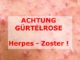Herpes-Zoster Gürtelrose © depositphotos.com @ viiwee