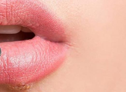 Bläschen an der Lippe das kann Lippenherpes sein! ©Herpotherm