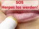 5 Tipps-was-hilft-gegen-Herpes Lippenherpes Wissen