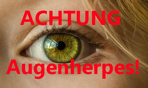 Augenherpes Verwechslung Was Tun Gegen Herpes